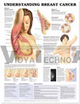 Understanding Breast Cancer Anatomical Chart, 1st Edition - Styrene Plastic